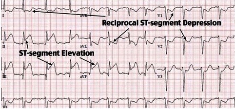 40-Inf MI ECG - ED Quality Solutions, LLC